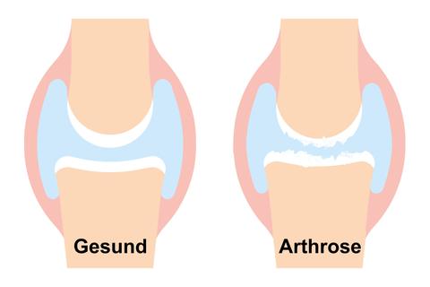Arthrose: Abnützung der Gelenke – © Canva