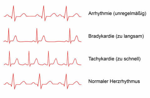 Herzrhythmusstörungen: Unterscheidung von drei verschiedenen Formen – ©Ekaviso/stock.adobe.com_adaptiert