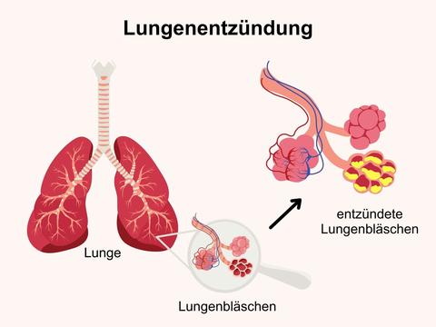 Lungenentzündung: Entzündung der Lungenbläschen oder des Lungengewebes - © Canva