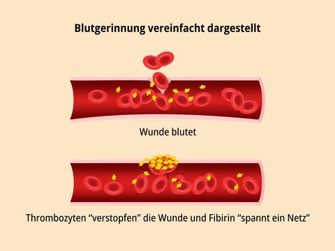 Blutgerinnung vereinfacht dargestellt - © Canva