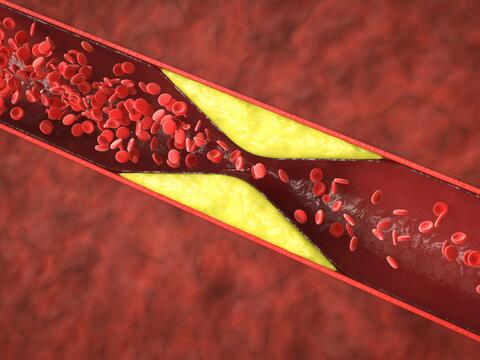 Arteriosklerose - © Canva