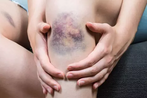 Stumpfe Verletzung: Beispiele und Behandlung - © Canva