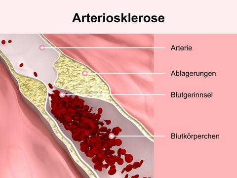 Arteriosklerose: Gefäßverkalkung in den Arterien – © Canva