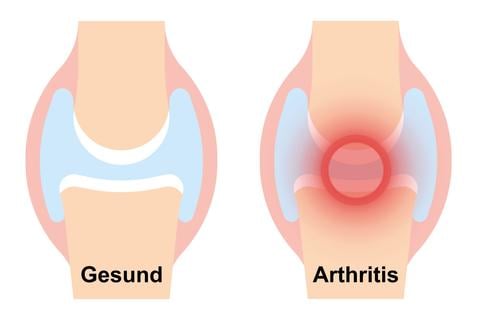 Bei Arthritis sind Gelenke von einer Entzündung betroffen – © Canva