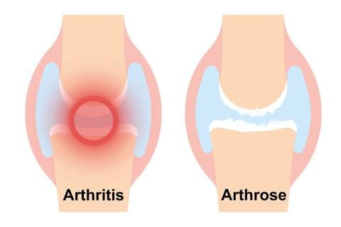 Arthritis Arthrose Unterschied - © Canva