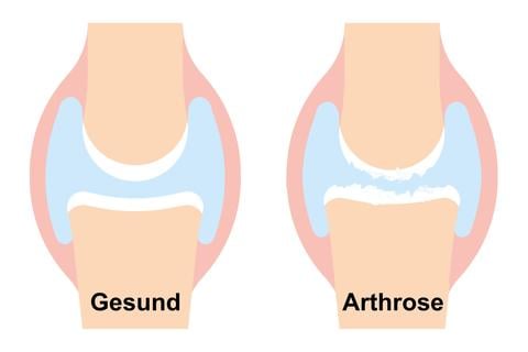 Arthrose: Abnützung der Gelenke – © Canva