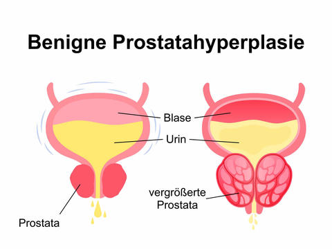Benigne Prostatahyperplasie – © Canva