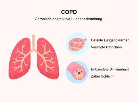 COPD: Was die chronische Erkrankung ausmacht - © Canva