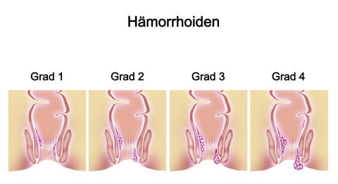 Hämorrhoiden Grade: Unterschiedliche Einteilung von Hämorrhoidalleiden - ©New Africa/stock.adobe.com_adaptiert