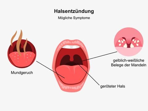 Mögliche Symptome bei einer Halsentzündung - ©Canva