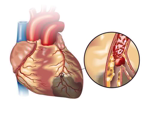 Herzinfarkt: Verstopfung der Herzkranzgefäße – © Axel Kock/stock.adobe.com