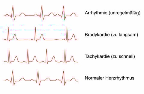 Herzrhythmusstörungen: Unterscheidung von drei verschiedenen Formen – ©Ekaviso/stock.adobe.com_adaptiert