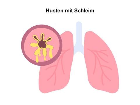 Husten mit Schleim - © Canva