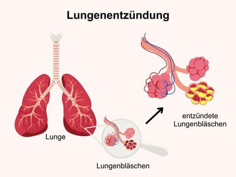 Lungenentzündung: Entzündung der Lungenbläschen oder des Lungengewebes - © Canva