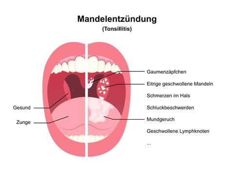 Mandelentzündung - © Canva