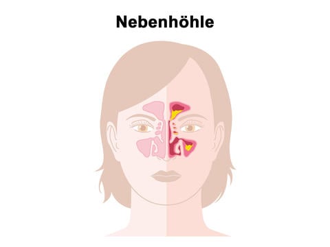 Nebenhöhle: Schnupfen oder Sinusitis? - © Axel Kock/stock.adobe.com