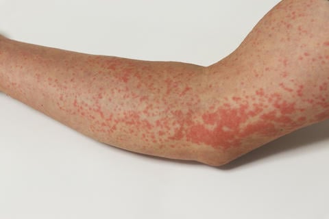 Nesselsucht: Symptome und mögliche Ursachen – ©ZOKO/stock.adobe.com