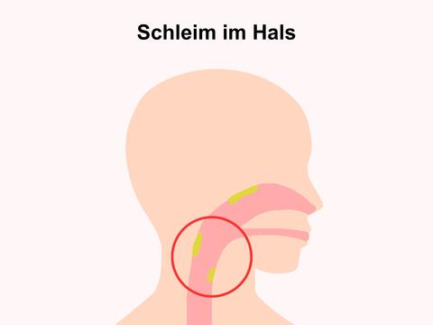 Schleim im Hals: Funktion, Ursachen, Behandlung, Tipps - © Canva