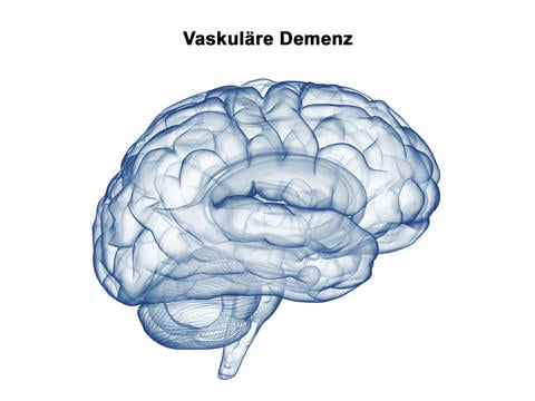 Vaskuläre Demenz: eine Sonderform der Demenz - © ag visuell/stock.adobe.com