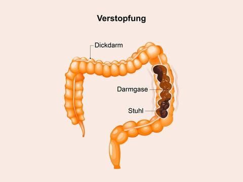 Verstopfung und wie Sie dagegen vorgehen können - © designua/stock.adobe.com_adaptiert