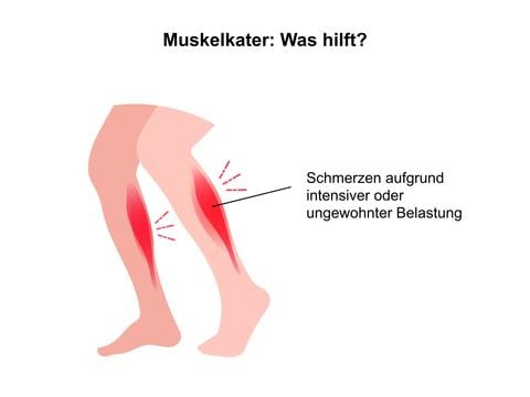 Was hilft bei Muskelkater - © Canva