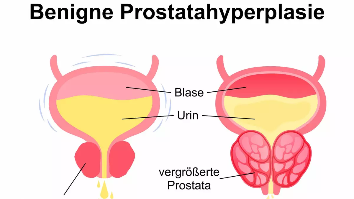 Benigne Prostatahyperplasie (BPH) | Schwabe Austria