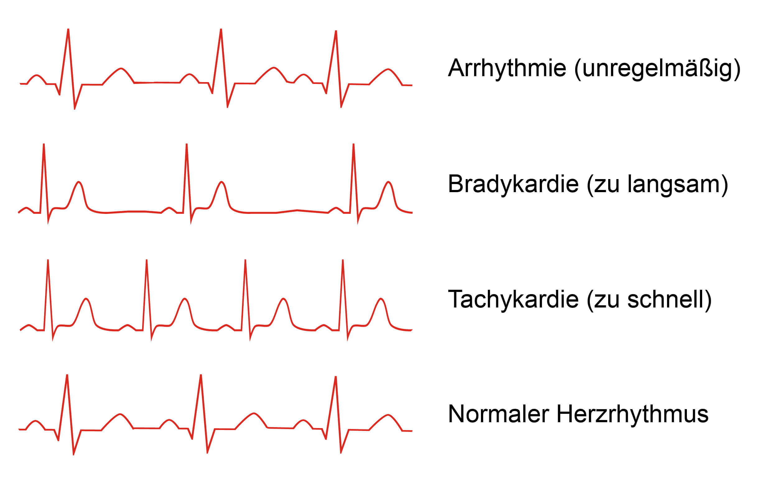 Herzrhythmusstörungen: Überblick Arrhythmien | Schwabe Austria