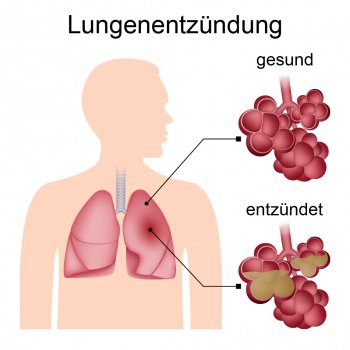 Anzeichen einer Lungenentzündung Wenn aus Husten eine Lungenentzündung wird - © anatolir/stock.adobe.com_adaptiert