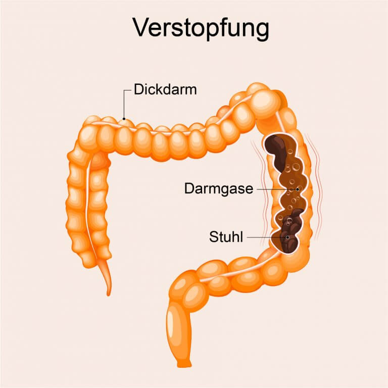 Was tun bei akuter Verstopfung