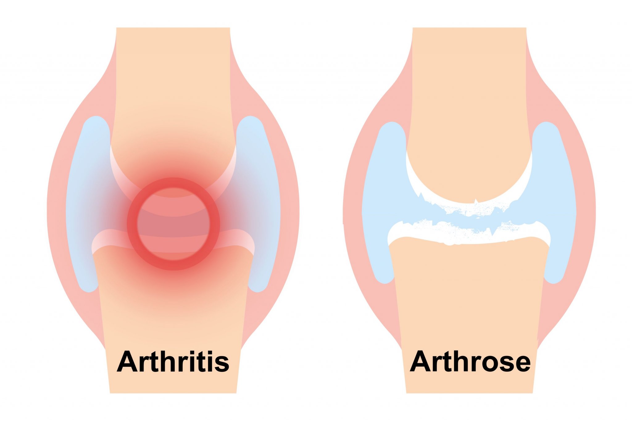 Arthrose von Arthritis unterscheiden Schwabe Austria