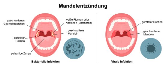 Mandelentzündung | Schwabe Austria